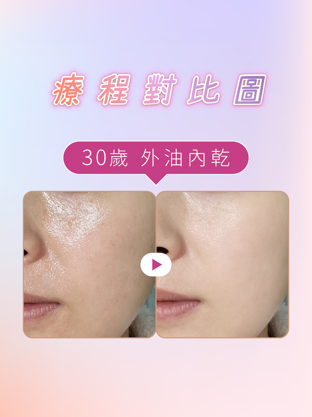 iff 啞光肌養成 對比參考 2