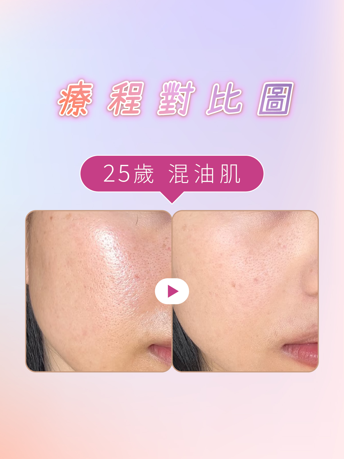 iff 啞光肌養成 對比參考 4